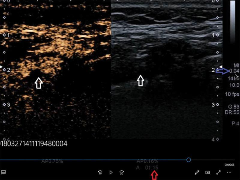 Badanie CEUS – faza żylna, wypełnienie światła naczynia – zatarta granica światło naczynia–blaszka; strzałka niebieska – wartość MI, strzałka biała – obszar badanej blaszki (materiał własny)