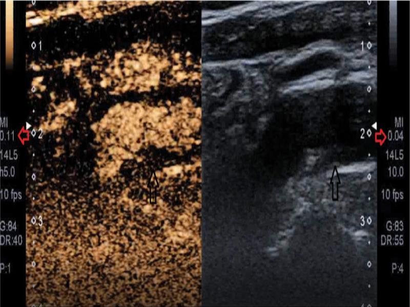 CEUS: microcirculation phase. Obliterated vessel lumen– plaque boundary; black arrow – plaque area under examination, red arrow – MI value (present authors’ own material)