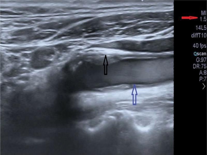 Late phase, replenish mode, black arrow – plaque–vessel wall boundary, blue arrow – plaque–vessel lumen boundary, red arrow – MI value (present authors’ own material)