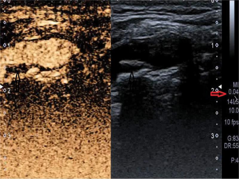 CEUS using the classic method: visible contrast agent microsphere echoes in atherosclerotic plaque’s topography on the posterior wall of the vessel; black arrow – image of plaque with UEA echoes, red arrow – MI value (present authors’ own material)
