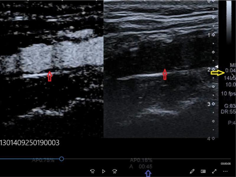 CEUS using the modified classic method; red arrows – atherosclerotic plaque, blue arrow – time of contrast agent administration, yellow arrow – MI value (present authors’ own material)