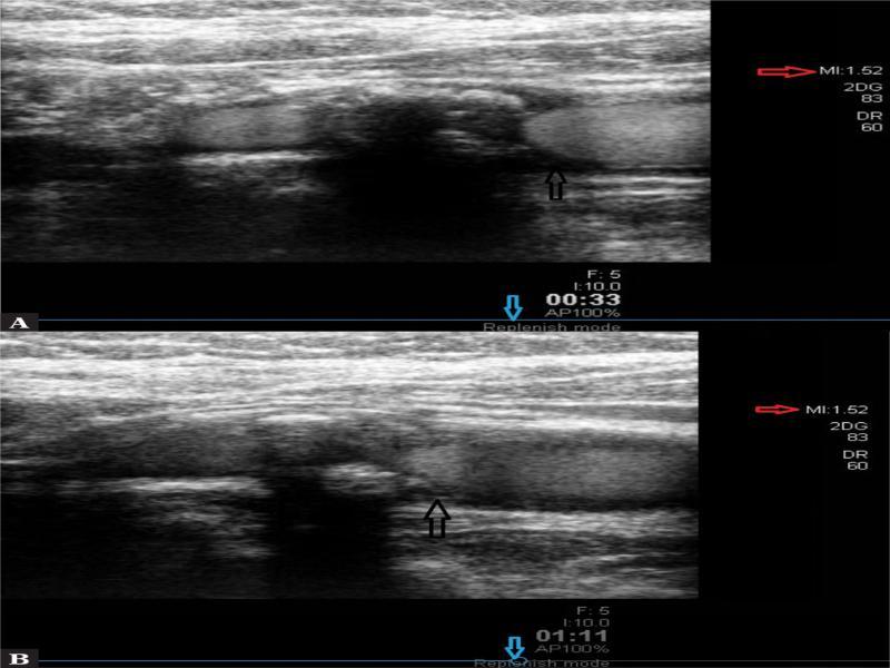 CEUS using the transient method: visible echoes of the contrast agent in atherosclerotic plaque’s topography on the posterior wall of the vessel, GWN type (class) III circular plaque. A. Time: 33 sec from administration. B. Time: 111 sec from UEA administration; black arrow – plaque area with contrast agent echoes, blue arrow – image of the method, red arrow – MI (present authors’ own material)