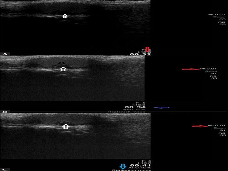 CEUS using the TMIP method, replenish-flash mode: visible echoes of the contrast agent in atherosclerotic plaque’s topography on the posterior wall of the vessel, GWN type (class) I plaque. A. Before PD pulse. B. During the pulse. C. After PD pulse; white arrow – atherosclerotic plaque with contrast agent echoes; red arrow – MI value during the scan; blue arrow – indication of the method (present authors’ own material)