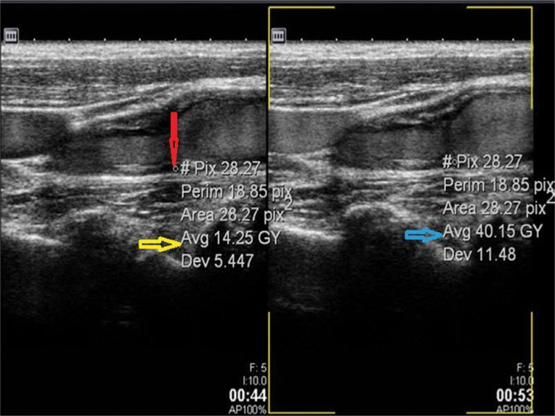 Evaluation of the change of plaque enhancement with the contrast agent on GSM analysis. Red arrow – ROI, yellow and blue arrows – GSM values (present authors’ own material)