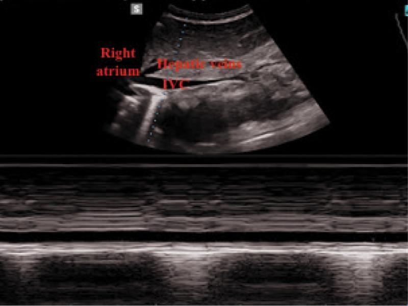 M-Mode images of the inferior vena cava draining into the right atrium