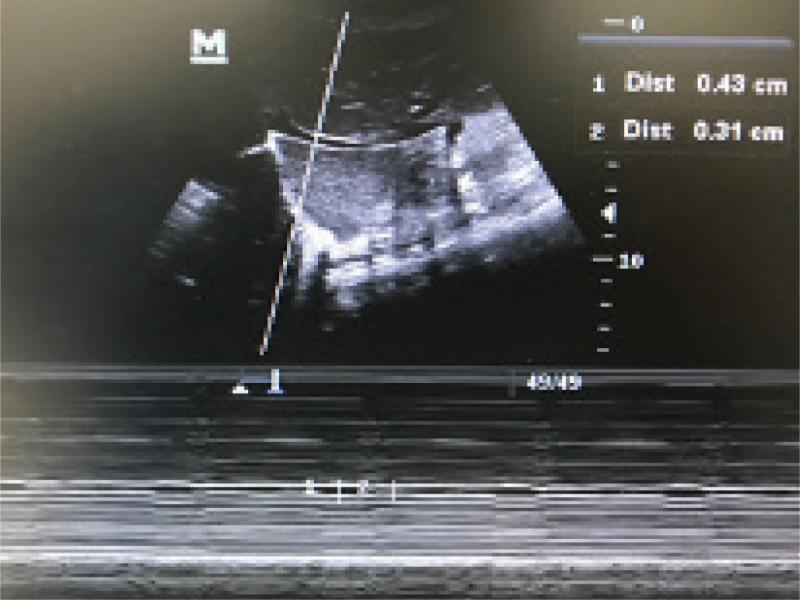 Maximum and minimum diameter measurements of the inferior vena cava on breathing circulation IVC