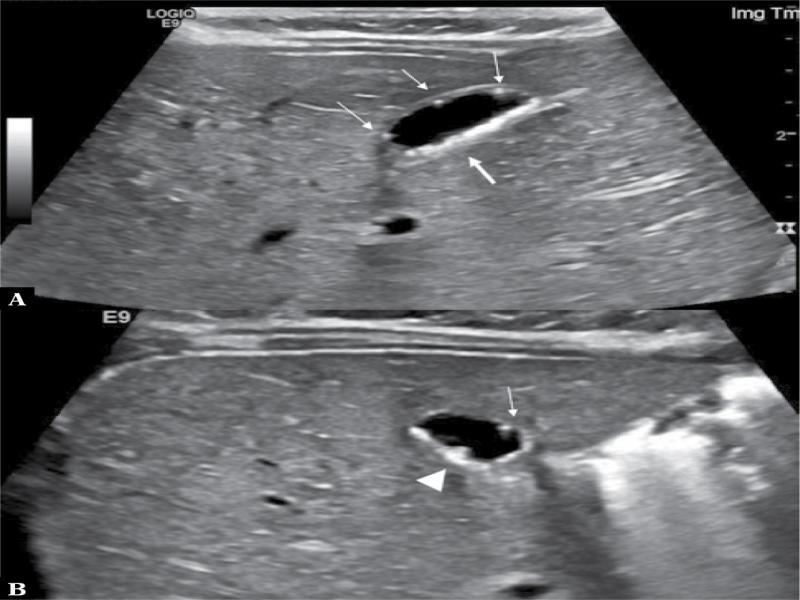 Longitudinal (
A
) and axial (
B
) images of the gallbladder in a 3-month-old infant. There are multiple nondependent echogenic foci at the gallbladder wall with distal comet tail artifacts, in keeping with the typical Rokitansky-Aschoff sinuses (thin arrows). There is echogenic material in the dependent part of the gallbladder wall (thick arrow) that is not causing any acoustic shadowing, in keeping with bile sludge. There is a small accumulation of sludge in the wall protruding inside the gallbladder lumen, creating a polypoid projection (arrowhead)