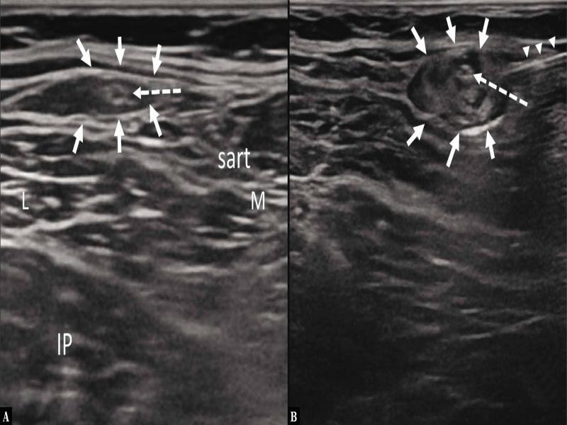 A. Axial ultrasound image of the lateral thigh, showing lateral femoral cutaneous nerve (LFCN; hatched arrows) above the sartorius muscle (sart). Iliopsoas muscle (IP), (arrows) fat pad. B. Ultrasound-guided perineural needle positioning (arrowheads) with spread of the medication within the fat pad (arrows). L – lateral, M – medial