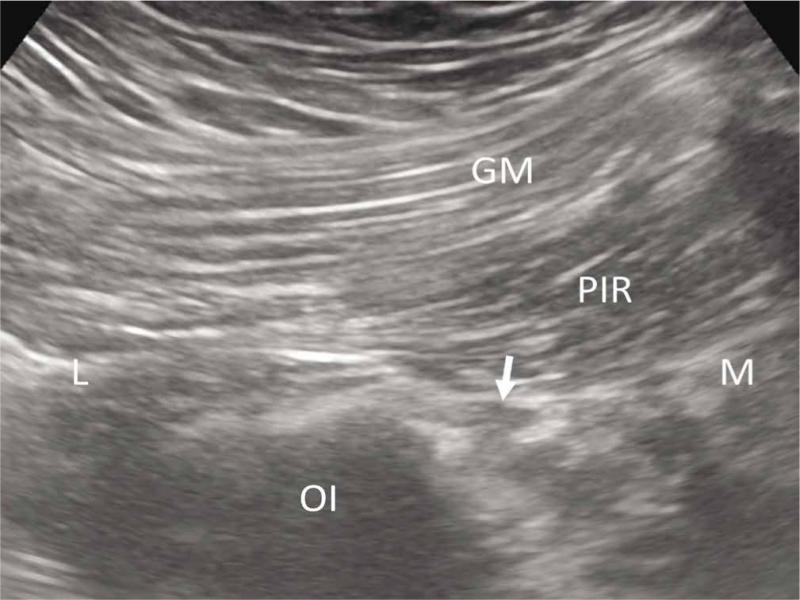 Ultrasound image showing the anatomic relations between the gluteus maximus (GM), piriformis muscle (PIR), the sciatic nerve (arrow) and os ischium (OI). L – lateral, M – medial
