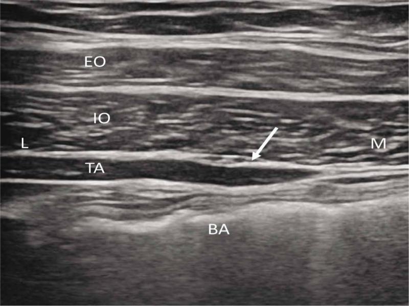 Ultrasound image showing anatomic relations between external oblique muscle (EO), internal oblique muscle (IO) and transversus abdominis muscle (TA). Arrow is depicting neurovascular bundle in the course of the ilioinguinal nerve, the injection for should be performed in its plane. (BA) bowel air. L – lateral, M – medial