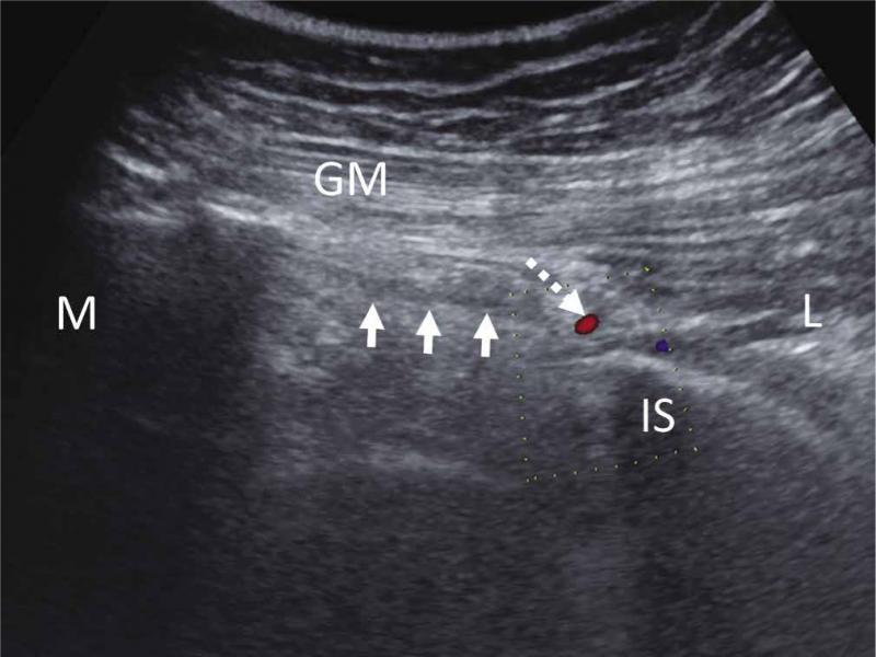 Ultrasound image showing anatomic relations between (IS) ischial spine, sacrospinous ligament (arrows) and internal pudendal artery (hatched arrow). The pudendal nerve is deep lies adjunct to the internal pudendal artery. L – lateral, M – medial