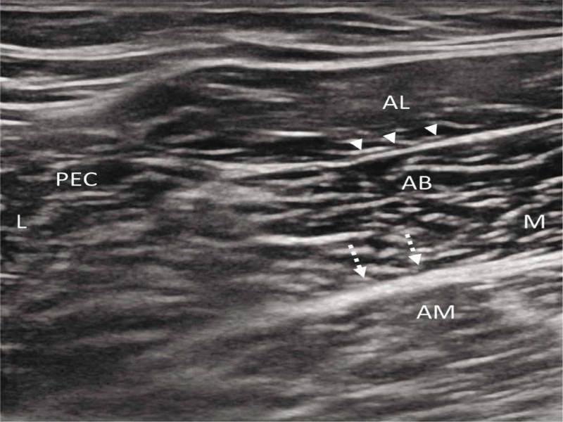 Ultrasound image shows anatomic relations between adductor muscles. The anterior branch of the obturator nerve lies within fascia (arrowheads) between the adductor longus muscle (AL) and adductor brevis muscle (AB). The posterior branch of the obturator nerve lies within fascia (hatched arrows) between the adductor brevis (AB) muscle and adductor magnus muscle (AM). L – lateral, M – medial