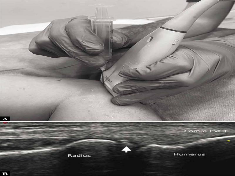 Elbow joint injection. A. Transducer and needle positioning for simulated elbow joint injection. B. On a longitudinal US scan, the humeroradial joint is depicted underneath the common extensor tendon (Comm Ext T). A 21-gauge needle (arrow) is inserted into the joint using an out-of-plane approach