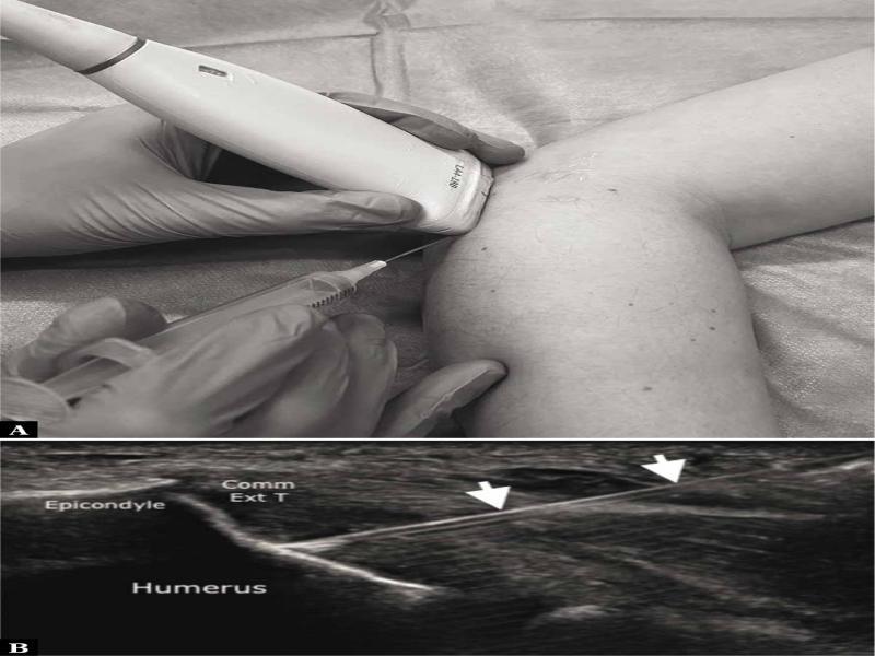 Common extensor tendon dry needling. A. Transducer and needle positioning for simulated common extensor tendon dry needling. B. The common extensor tendon (Comm Ext T) is thickened and degenerated at its attachment to the lateral epicondyle. A 21-gauge needle (arrows) is inserted into the degenerated areas of the tendon using an in-plane distal-to-proximal approach, and repeated punctures are performed