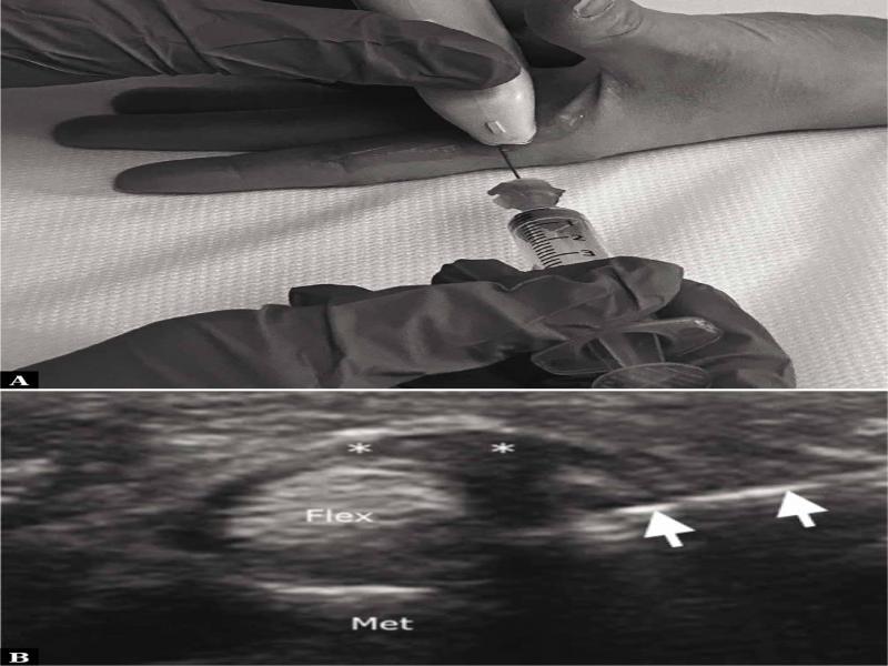 Trigger finger injection. A. Transducer and needle positioning for simulated trigger finger injection. B. At the level of the metacarpal head (Met), the flexor tendons (Flex) are shown, and the A1 pulley (asterisks) is thickened. A 25-gauge needle (arrows) is inserted underneath the pulley using an in-plane axial approach