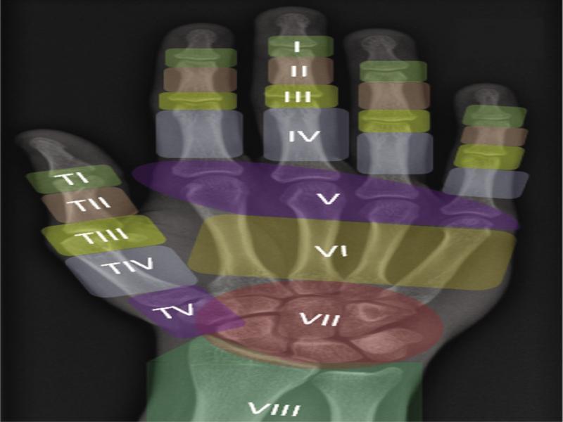 Zonal classification of extensor tendon injuries: from distal to proximal, odd numbers conventionally refer to specific joint levels. In the fingers: zone I indicates the DIP joint level, zone III the PIP joint, zone V the MCP joint; in the thumb: the IP joint level is zone I, the MCP joint is zone III