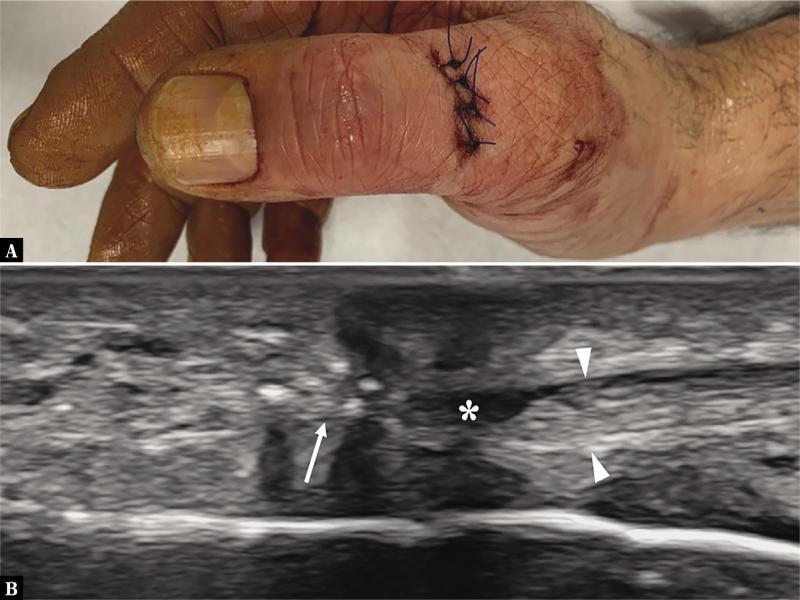 Extensor pollicis longus full-thickness tear. A. Photograph showing a sutured wound over the dorsal thumb due to a penetrating injury by a glass fragment. B. After repair, long-axis 22–8 MHz US image shows signs of extensor pollicis longus retear. Note the subtotal discontinuity of the proximal tendon end (arrowheads) which appears retracted away from the sutures (thin arrow). Mild fluid (asterisk) fills the gap