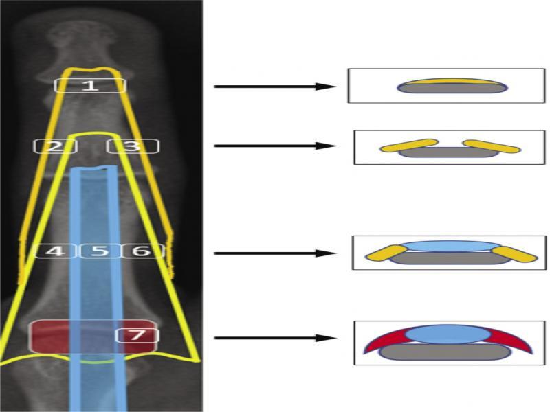 Schematic drawing of the extensor mechanism of the fingers with corresponding transverse slices: (1) terminal tendon, (2) lateral conjoined tendon, (3) medial conjoined tendon, (4) lateral slip, (5) central slip, (6) medial slip (7) sagittal bands