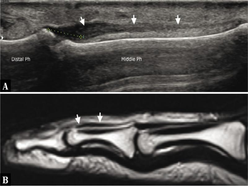 Mallet finger. A. On a longitudinal sonogram, the extensor tendon of the fourth finger (arrows) is completely torn from the distal phalanx (Distal Ph) base. The tendon stump is thickened and hypoechoic at the level of the distal third of the middle phalanx (Middle Ph). Tendon retraction (caliper) measured 4–5 mm. B. On a longitudinal T2-weighted MRI image, the extensor tendon retraction (arrows) is shown in the same patient