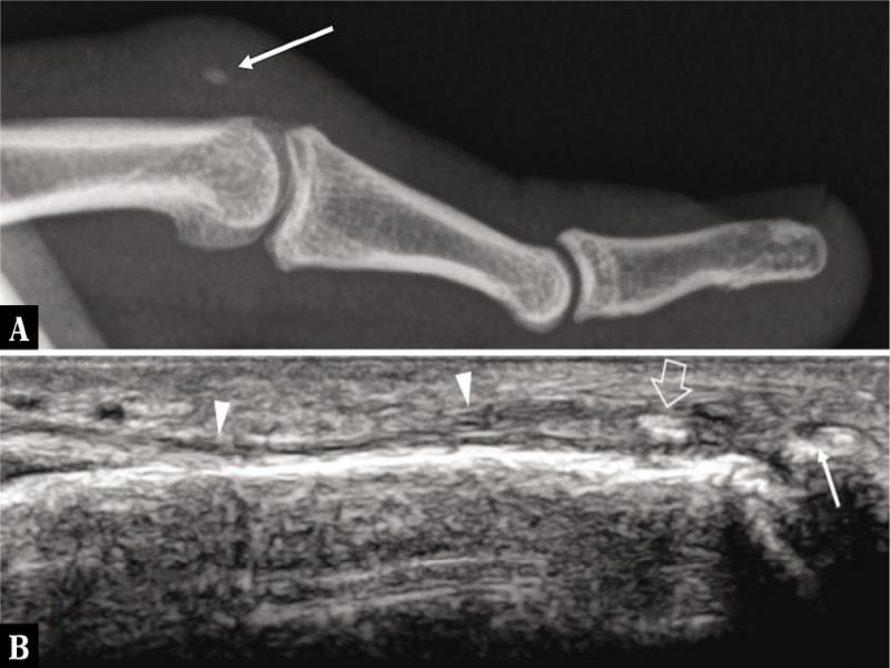 Boutonniere deformity. A. Lateral radiograph and B. corresponding long-axis 17–5 MHz US image of the middle finger demonstrate a small piece of bone (arrow) avulsed from the base of the middle phalanx. In B, the donor site of avulsion (thin arrow) is shown as a small concavity at the base of the middle phalanx. The retracted fragment (large arrow) is in continuity with the central slip (arrowheads) of the extensor hood