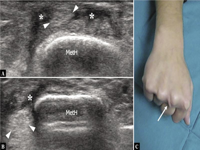 Sagittal band injury. A, B. Transverse 17–5 MHz US images over the dorsal aspect of the metacarpal head (MetH) of the right third finger acquired in extension (A) and in clenched-fist (B) position show transient ulnar dislocation of the common extensor tendon (arrowheads) during flexion. Mild local effusion (asterisks) is observed along the tendon path. C. Correlative photograph showing tendon dislocation (arrow) on the ulnar side of the third metacarpal head