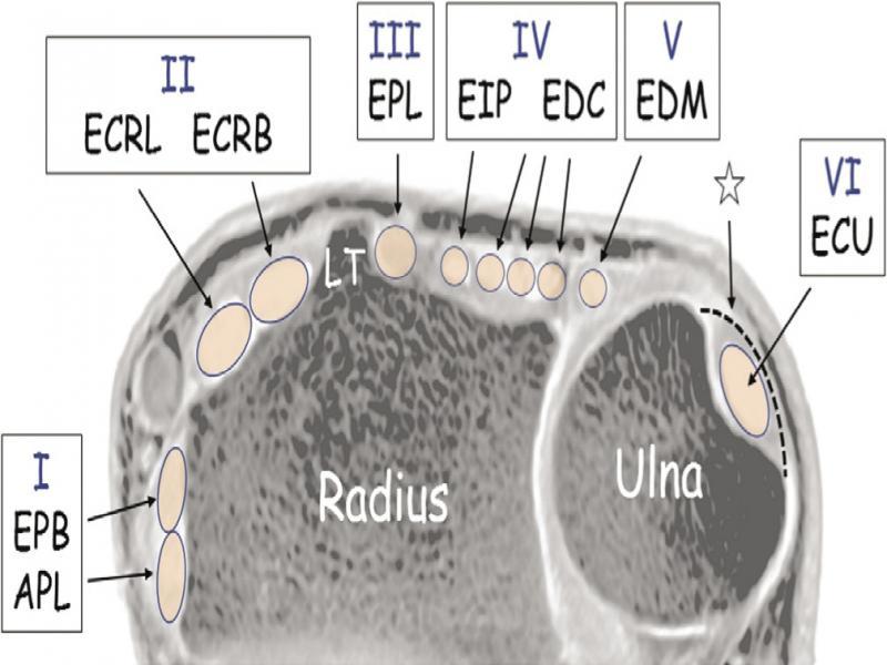 Schematic drawing of the six extensor tendon compartments of the wrist, labeled from I-VI, adapted from(34). APL – abductor pollicis longus; EPB – extensor pollicis brevis; ECRL – extensor carpi radialis longus; ECRB – extensor carpi radialis brevis; EPL – extensor pollicis longus; EIP – extensor indicis proprius; EDC – extensor digitorum communis; EDM – extensor digiti minimi; ECU – extensor carpi ulnaris; Asterisk – subsheath; LT – Lister’s tubercle; Note the retinacula for each compartment are removed for better visibility