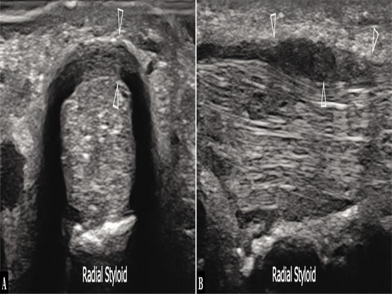 De Quervain’s syndrome. Short- (A) and long-axis (B) 24–8 MHz US images over the radial styloid reveal a thickened, hypoechoic retinaculum (arrowheads) and the swollen abductor longus and extensor pollicis brevis tendons. Note that the two tendons form a rounded complex and cannot be separated from each other, being constricted by the abnormal retinaculum