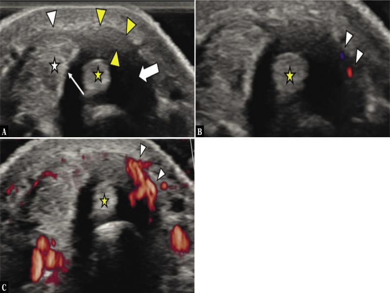 De Quervain’s syndrome in a 20-year-old patient, related to selective entrapment of the extensor pollicis brevis by a thickened retinaculum. A. Transverse US image shows a vertical septum (thin white arrow) dividing the two tendons in the first compartment. Fluid (thick white arrow) is seen surrounding the extensor pollicis brevis tendon (EPB; yellow asterisk) due to tenosynovitis. Note the thickening of the surrounding retinaculum (yellow arrow heads). The abductor pollicis longus (white asterisk) and the ventral part of the retinaculum (white arrowhead) are unaffected. The transverse color Doppler image (B) and transverse power Doppler image (C) show increased vascularization (arrow heads) surrounding the EPB tendon due to tenosynovitis
