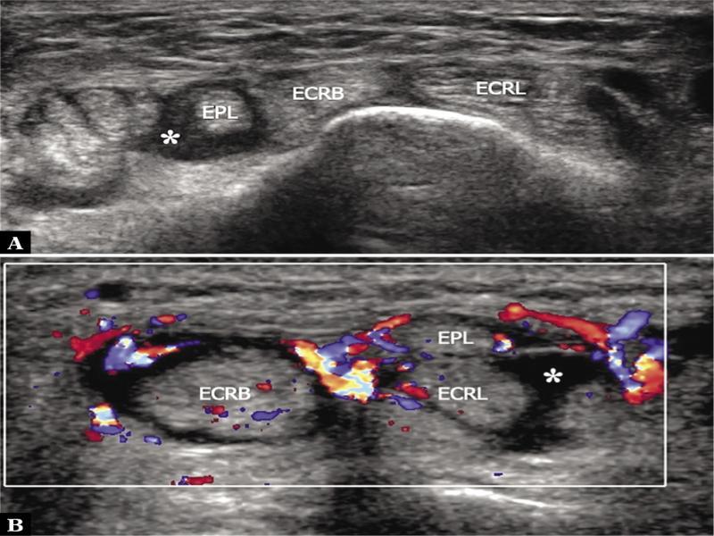 Distal intersection syndrome. A. Proximal to the criss-crossing point, transverse 17–5 MHz US image shows a distended sheath (asterisk) of the extensor pollicis longus (EPL) as it runs alongside the ulnar aspect of the extensor carpi radialis brevis (ERCB) and extensor carpi radialis longus (ECRL). B. More distally, transverse 17–5 MHz color Doppler US image demonstrates the extensor pollicis longus (EPL) as it crosses over the extensor carpi radialis brevis (ECRB) and longus (ECRL) tendons. The sheath of the second and third compartments appears mildly distended by tenosynovitis with effusion (asterisk). Note diffuse local hyperemia and the swollen appearance of the ECRB