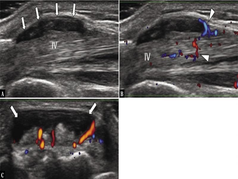 Tenosynovitis of the fourth extensor compartment in a patient with psoriatic arthritis. A. Longitudinal US image with fluid, thickened synovium, and thickened retinaculum (white arrows) around the tendons in the fourth extensor compartment and increased vascularity on longitudinal (B) and transverse color Doppler (C) images, both in the synovium and the tendons