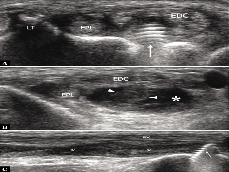 Screw tip impingement and tear of the extensor indicis proprius tendon in a 45-year-old woman after volar plating for distal radial fracture. A. Transverse 17–5 MHz US image obtained at the level of Lister’s tubercle (LT) reveals the thread and tip of a screw (thin arrow) impinging the extensor indicis proprius tendon. Note the intact extensor pollicis longus (EPL) and the displaced slips of the extensor digitorum communis (EDC). B. Transverse 17–5 MHz US image obtained proximal to A demonstrates the retracted extensor indicis proprius (arrowheads) surrounded by effusion and debris (asterisk). C. Longitudinal 17–5 MHz US image demonstrates the screw (thin arrow) and the empty sheath (asterisks) of the extensor indicis proprius filled with debris and hypoechoic effusion. Note the normal-appearing tendons of the extensor digitorum communis (EDC) as they run more superficially