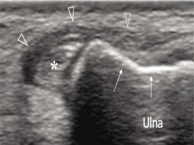 DExtensor carpi ulnaris (ECU) instability. ECU instability in a patient with long-standing rheumatoid arthritis. US image demonstrates the ECU tendon (white asterisk) dislocated out of the groove (white arrows). The subsheath (void arrowheads) appears lax, wavy, and displaced out of the groove