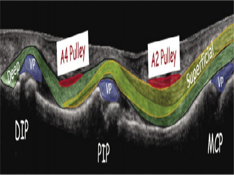 Drawing of the flexor tendons of the finger, superimposed on US image. Superficial – flexor digitorum superficialis tendon (yellow), Deep – flexor digitorum profundus tendon (green), DIP – distal interphalangeal joint, PIP – proximal interphalangeal joint, MCP – metacarpophalangeal joint, VP – volar plate