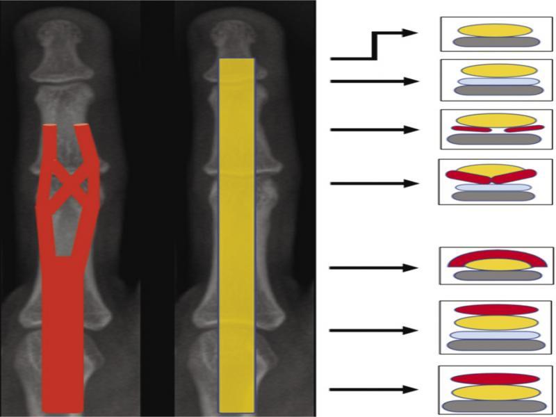 Schematic drawing of superficial (red) and deep (orange) finger flexor tendons with corresponding transverse slices. Palmar plate (blue), bone (grey)
