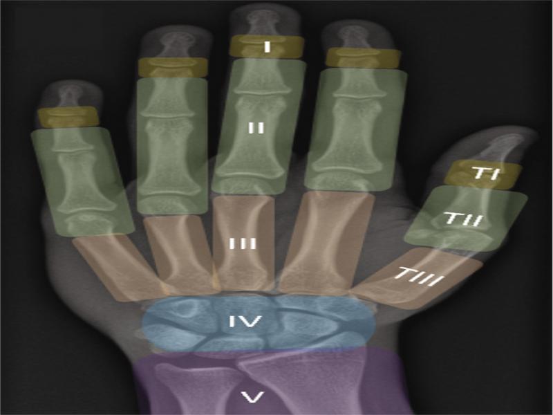 Zonal classification of flexor tendon injuries: Zone I distal to the flexor digitorum superficialis (FDS) insertions, Zone II between the FDS insertions and the level of A1 pulleys, Zone III between the proximal aspect of A1 pulleys and the lumbricals origin from the flexor digitorum profundus (FDP) tendons, Zone IV at the carpal tunnel region, Zone V from the distal myotendinous junction to the carpal tunnel, TI distal thumb to the IP joint, TII between thumb IP joint and A1 pulley, and TIII at the thenar eminence