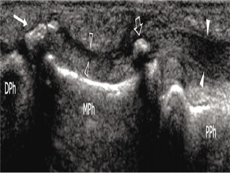 Jersey finger. Long-axis 12–5 MHz US image of the middle finger reveals fracture of the volar aspect of the base of the distal phalanx with fragmentation (thin arrow) and proximal migration of a small piece of bone (void arrow) up to the distal edge of the A3-pulley. Note the flexor digitorum profundus tendon (white arrowheads) attached to the avulsed fragment and the empty sheath (void arrowheads) distal to it. DPh – distal phalanx; MPh – middle phalanx; PPh – proximal phalanx