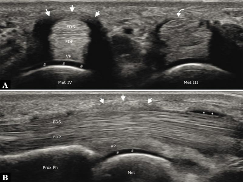 Trigger finger. A. On an axial sonogram at the level of the fourth metacarpal head (Met IV), the A1-pulley (straight arrows) is thickened (1.5 mm). Its collateral ligaments appear artifactually hypoechoic due to anisotropy. Note the healthy A1-pulley (curved arrow) at the level of the third metacarpal head (Met III). B. On a longitudinal sonogram, A1-pulley thickening is shown. The flexor digitorum superficialis (FDS) and flexor digitorum profundus (FDP) tendons show fibrillar echotexture and synovial sheath effusion (asterisks) is seen proximally. Hash marks indicate articular cartilage; Met – metacarpal; Prox Ph – proximal phalanx; VP – volar plate