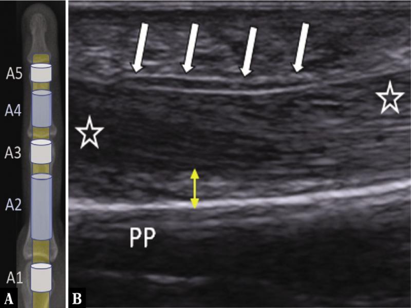 Schematic drawing of annular pulleys (A) and longitudinal US image (B) at the level of the proximal phalanx (PP) with normal thin appearance of the A2-pulley ligament (white arrows). Note the normal tendon-to-bone distance (TBD) of <2 mm (yellow double arrow). Flexor tendons (asterisks)