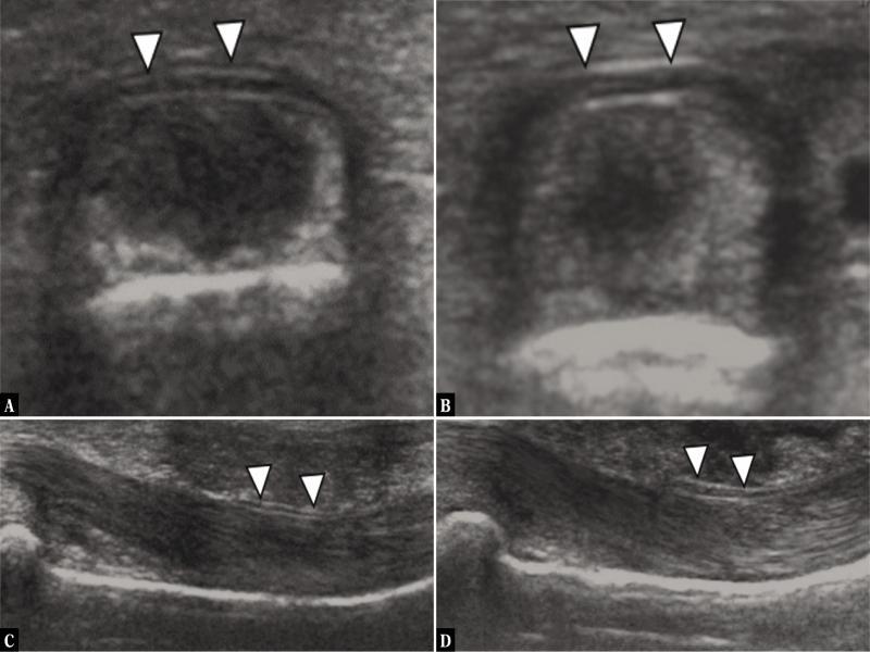 Transverse (A) and sagittal (C) US with normal thin appearance of A2-pulley (white arrowheads) with normal tendon-to-bone distance (TBD) in a non-climber. Transverse (B) and sagittal (D) US shows thickened A2 ligament (white arrowheads) due to chronic overuse in a climber. Images courtesy of Prof. A. Schweizer, Handsurgery, Balgrist University Hospital