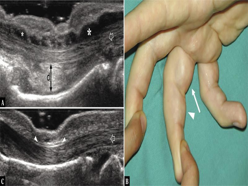 Annular pulley injury. A. Longitudinal 17–5 MHz US image obtained over the injured right long finger of a 15-year-old boy during resisted flexion of the distal interphalangeal joint demonstrates bowstringing and volar displacement of the flexor tendons (arrows) secondary to acute rupture of the A2-pulley. In this particular case, there was also a combined injury of the A3- and A4-pulleys (not shown). An increased tendon-to-bone distance (>2 mm, double arrow), is seen over the proximal phalanx. Note an abundant effusion (asterisks) distending the tenosynovial sheath. B. Corresponding photograph shows volar soft-tissue swelling over the proximal (thin arrow) and middle (arrowhead) phalanges due to bowstringing of the flexor tendons. C. Longitudinal 17–5 MHz US image over the left long finger illustrates the normal A2-pulley as a thin hypoechoic band (white arrowheads) retaining the flexor tendons (arrow) against the shaft of the proximal phalanx