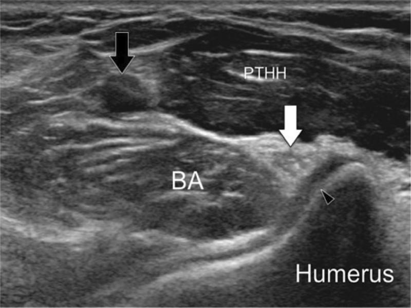 Transverse sonography over the proximal humeral head of pronator teres muscle depicting median nerve (white arrow) running deep between humeral head of pronator muscle (PTHH) and brachial anterior muscle (BA), with nerve located distally to brachial artery (black arrow)(17)