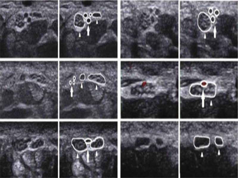 Transverse ultrasonographic image and marked image of bifid median nerve (white arrowhead) and persistent median artery (white arrow)(19)