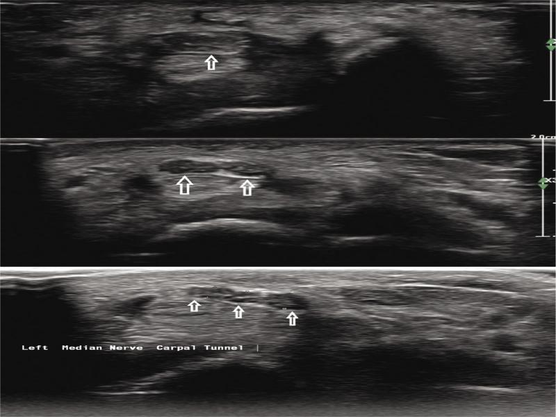 Transverse ultrasonographic image and marked image of trifurcation of median nerve at the level of carpal canal (white arrows). Reference: Medical Imaging. Riga East Clinical University Hospital