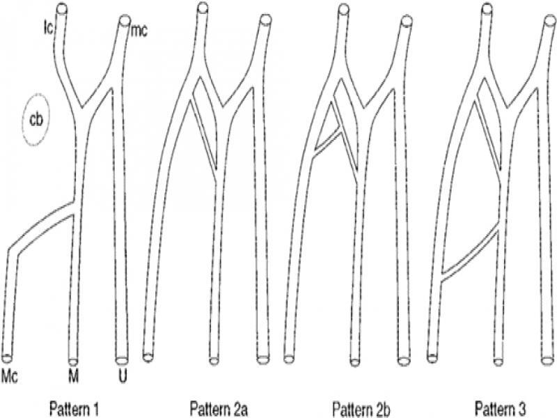 Patterns of connection between musculocutaneous and median nerves. cb, coracobrachialis muscle; lc, lateral cord; mc, medial cord; Mc, musculocutaneous nerve; M, median nerve; U, ulnar nerve(8)