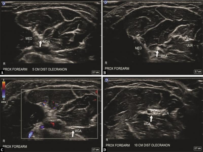 Transverse sonography showing Martin-Gruber anastomosis (MGA) branching off of median nerve (MED) 5 cm distal to olecranon (A) and running mediocaudally (B, C) and joining ulnar nerve (ULN) (D)(20)