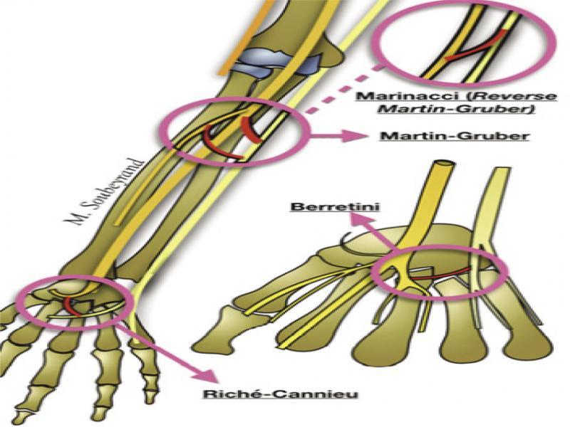 Summary of main anatomical interneural anastomosis of median nerve: MartinGruber anastomosis ‒ anastomosis from the main trunk of median nerve or interosseous anterior nerve to ulnar nerve; Marinacci anastomosis ‒ the reverse of Martin-Gruber anastomosis ulnar-to-median communication; Berretini anastomosis – communications between common digital nerves that arise from ulnar and median nerves in the palmar surface of hand; Riche-Cannieu anastomosis ‒ connection between the deep branch of ulnar nerve and recurrent branch of median nerve at thenar eminence(1)