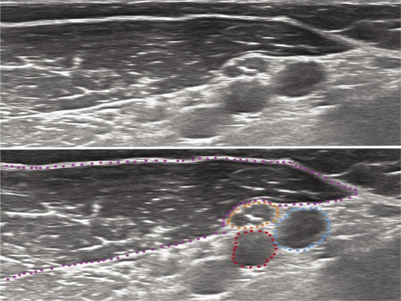 Transverse grayscale US of median nerve in upper arm; orange dotted circle – median nerve; red dotted circle – brachial artery; blue dotted circle – brachial vein; purple dotted line – biceps brachii muscle. Reference: Medical Imaging. Riga East Clinical University Hospital