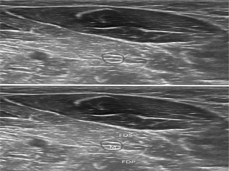 Transverse grayscale US of median nerve in forearm. M – median nerve; FDS – flexor digitorum superficialis muscle; FDP – flexor digitorum profundus muscle. Reference: Medical Imaging. Riga East Clinical University Hospital