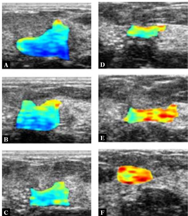 B-mode ultrasound images with overlaid parametric IBC images determined for a patient responding to NAC before (A) and one week after each chemotherapy cycle (B–F). Blue indicates low IBC values; red indicates high values