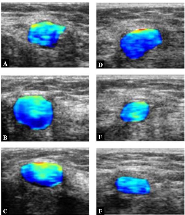 B-mode ultrasound images with overlaid parametric IBC images determined for a non-responder to NAC before (A) and one week after each chemotherapy cycle (B–F). Blue indicates low IBSC values; red indicates high values